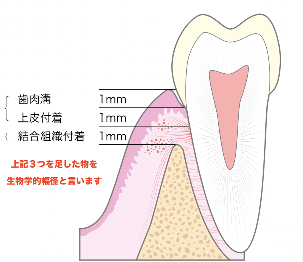 ガミースマイル治療の歯冠長延長術(クラウンレングスニング)と歯肉切除術(歯肉形成術)の違いについて解説!! - 本町の矯正・歯科 本町ノーブル ...