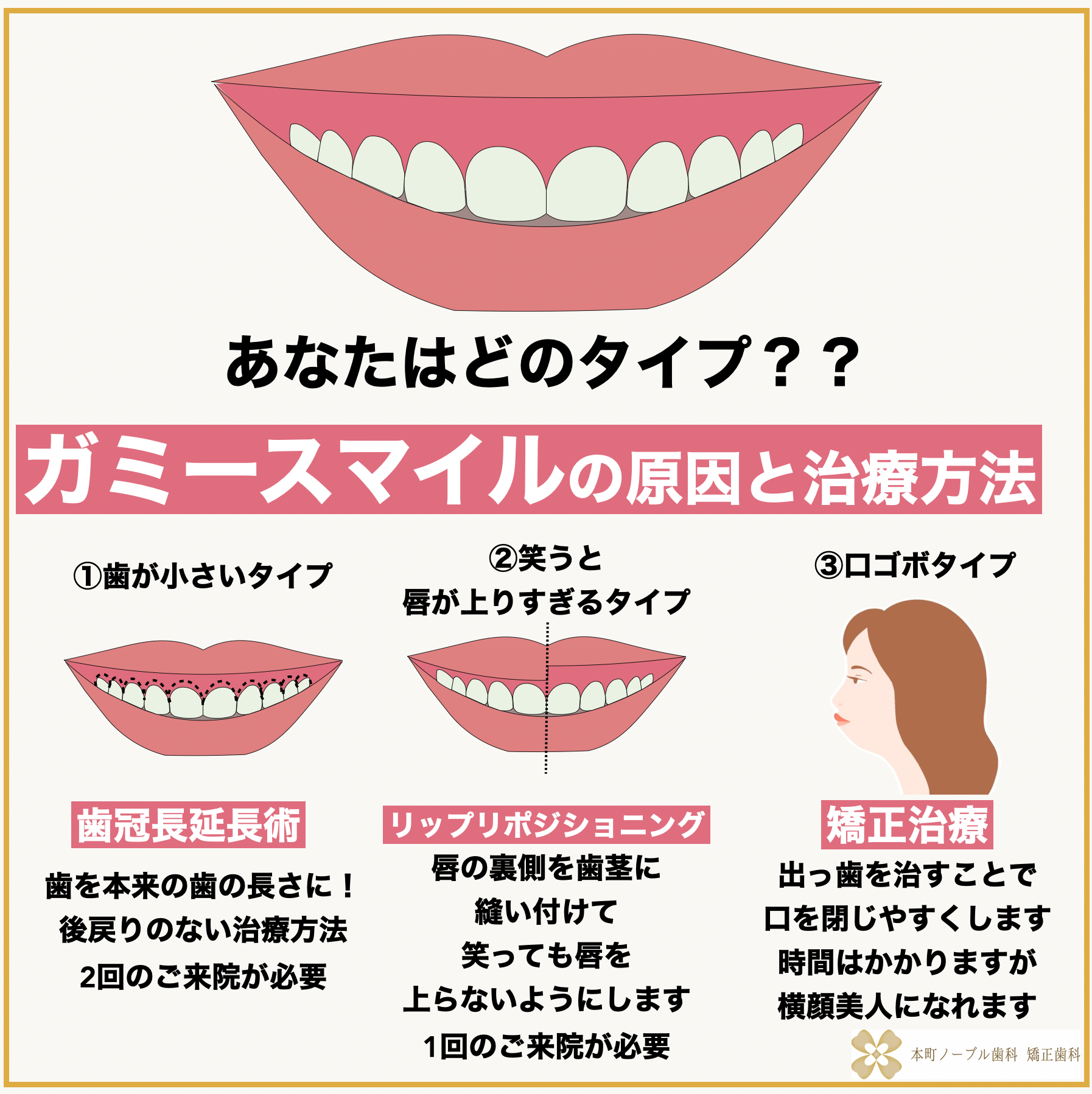 あなたはどの治療が必要？タイプ別ガミースマイルの原因と治療方法