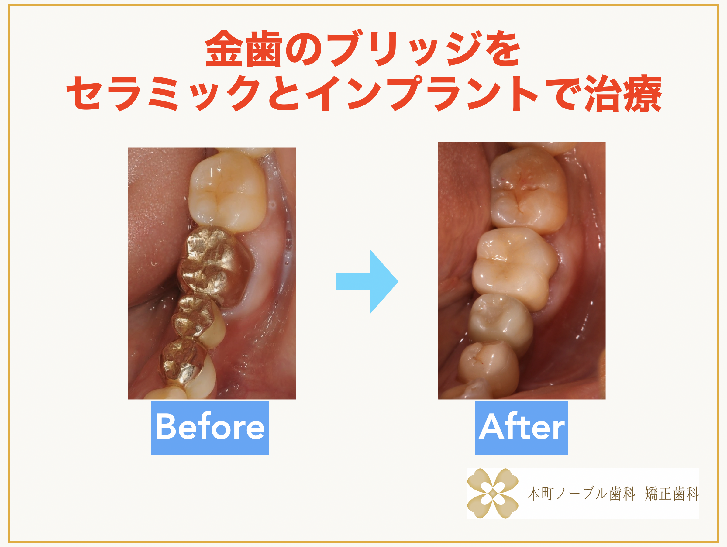 阿波座で「インプラント治療」するなら本町ノーブル歯科 矯正歯科