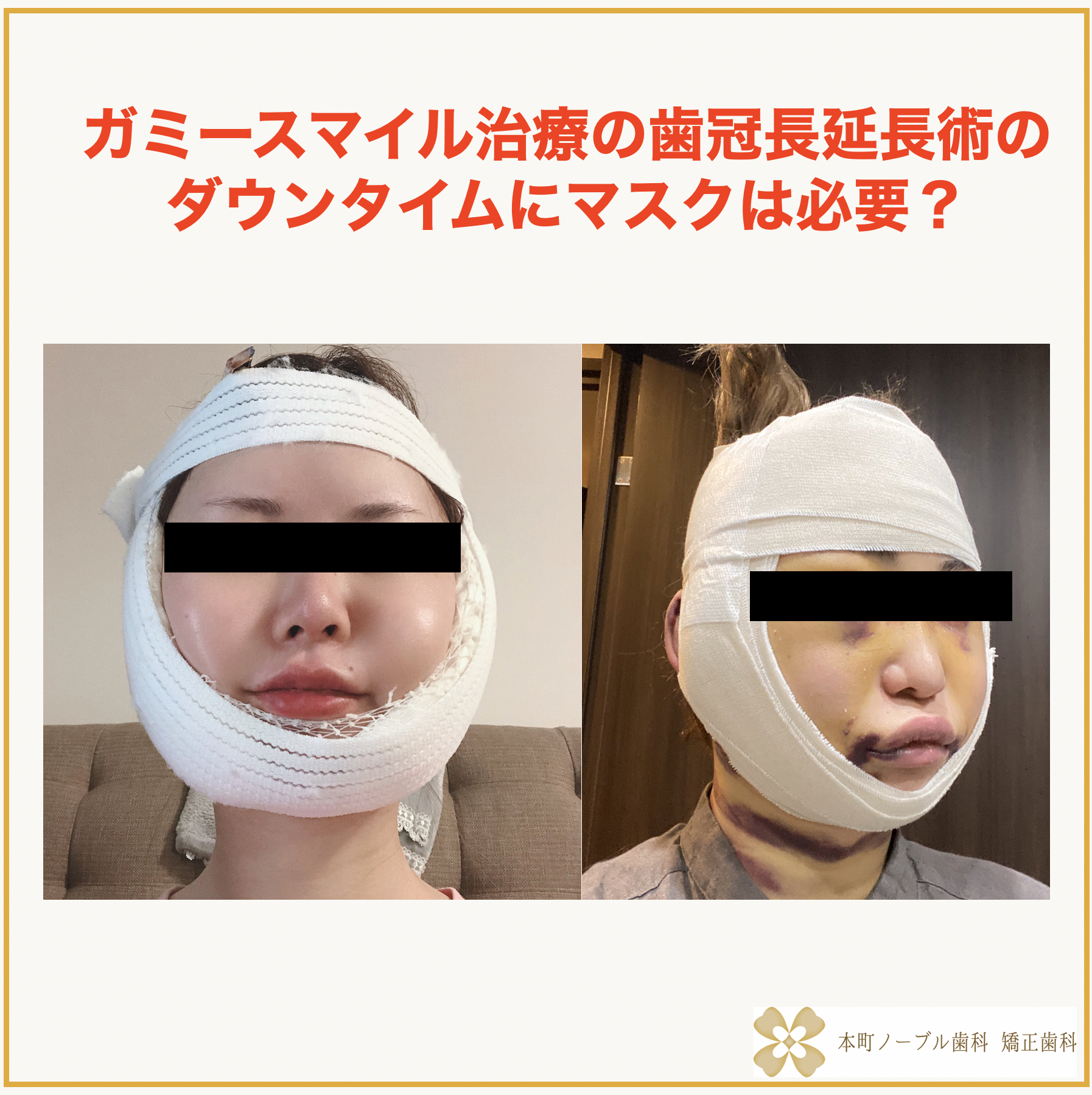 歯 冠 長 延長 術