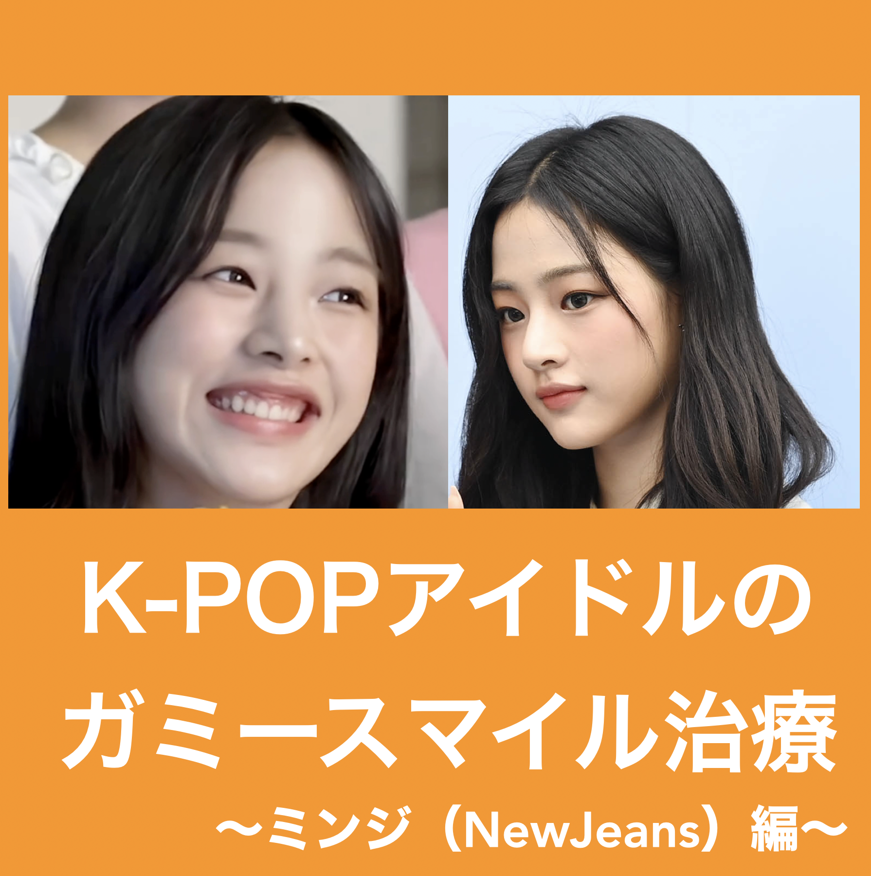 K-POPアイドルのガミースマイル治療〜ミンジ（NewJeans）〜 - 本町の