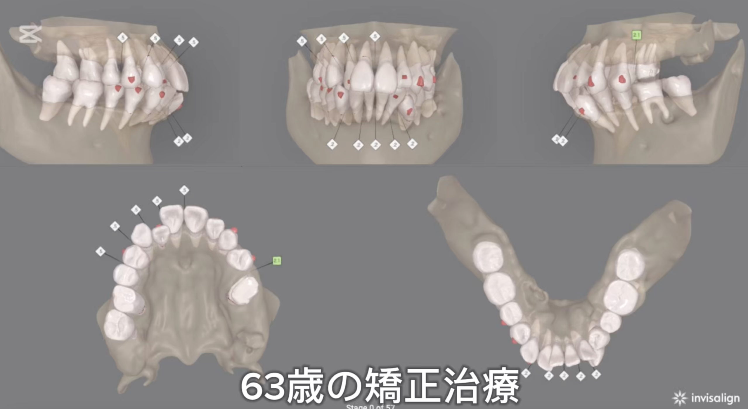 PANORAMIC RADIOLOGY SECOND EDITION　歯列矯正 60代の矯正治療 - 本町の矯正・歯科 本町ノーブル歯科 矯正歯科 歯並び