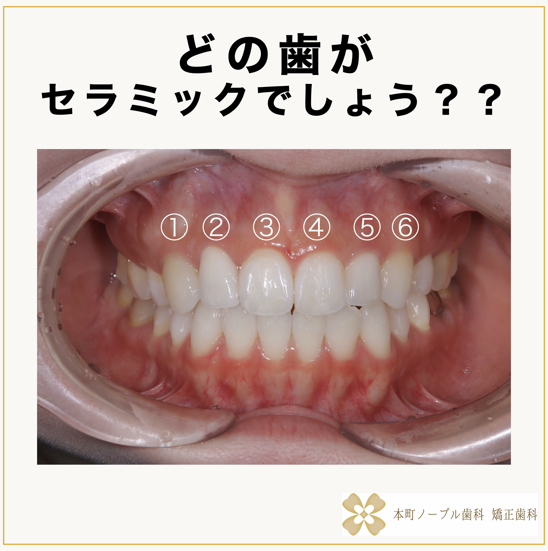 歯科矯正治療の基礎 どの歯がセラミックでしょう？ - 本町の矯正・歯科 本町ノーブル歯科