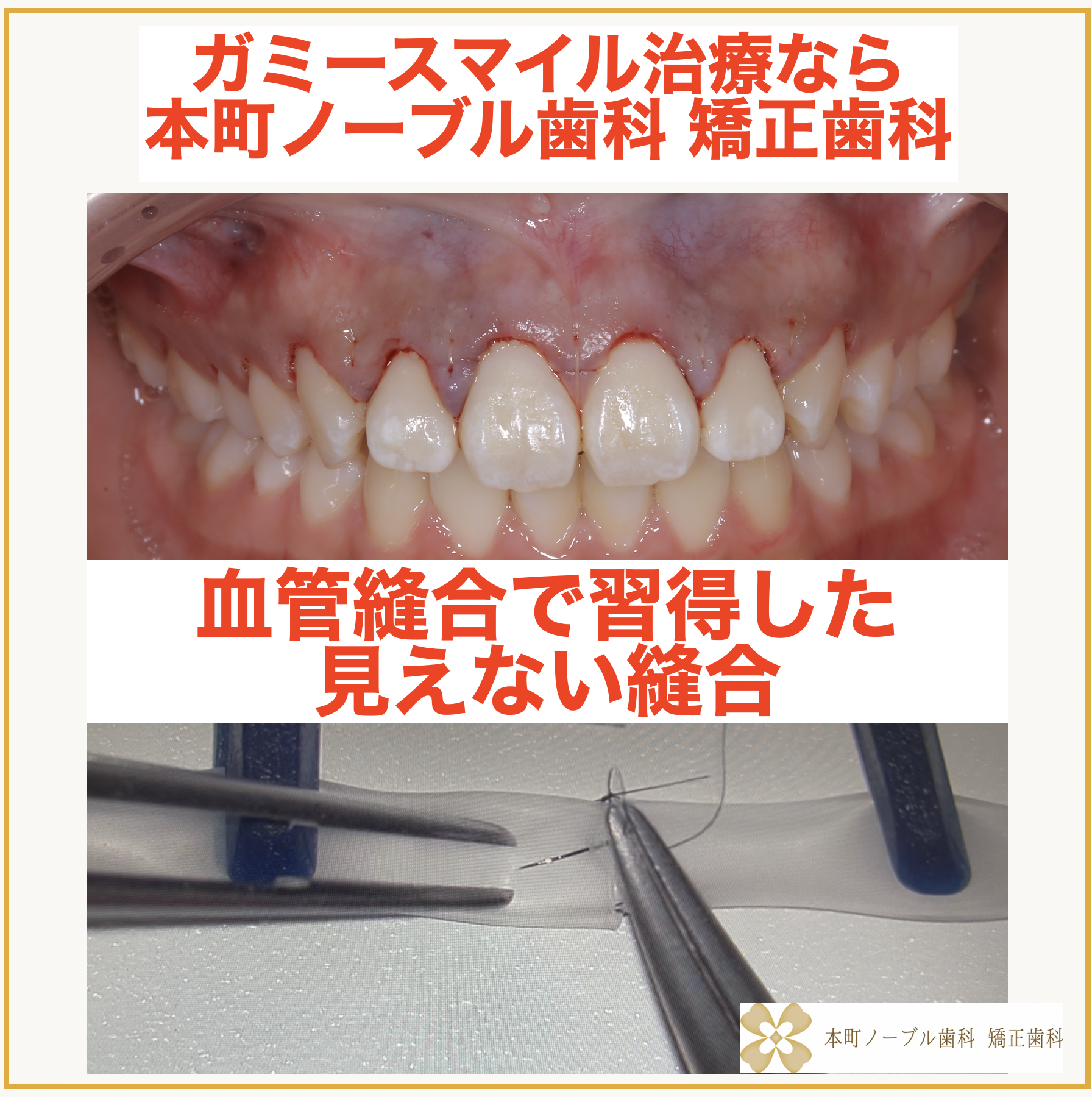 血管縫合で習得した『見えない縫合』でガミースマイル治療のダウン