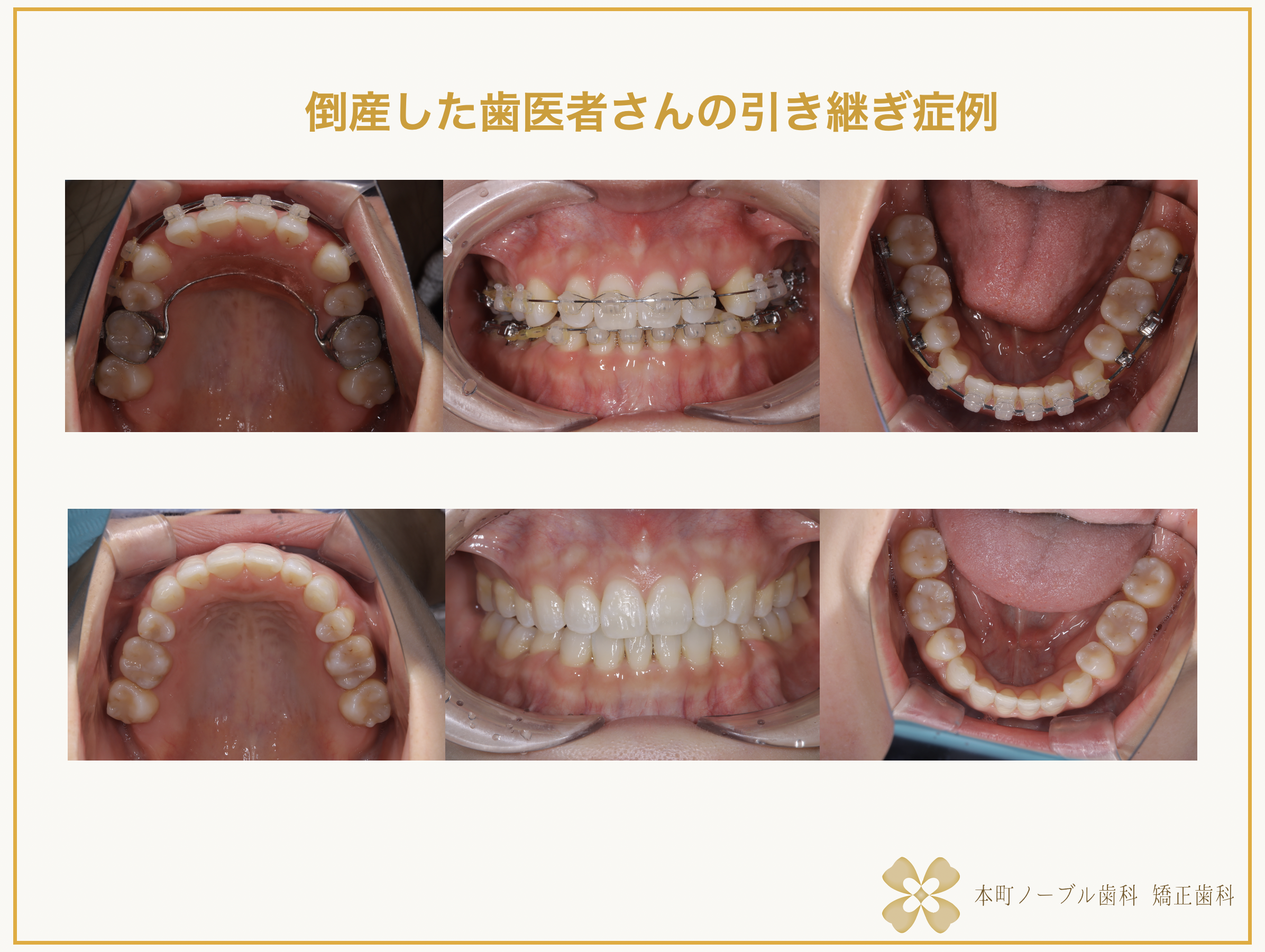 大阪の倒産した歯医者さんからの矯正治療の転院症例 - 本町の矯正