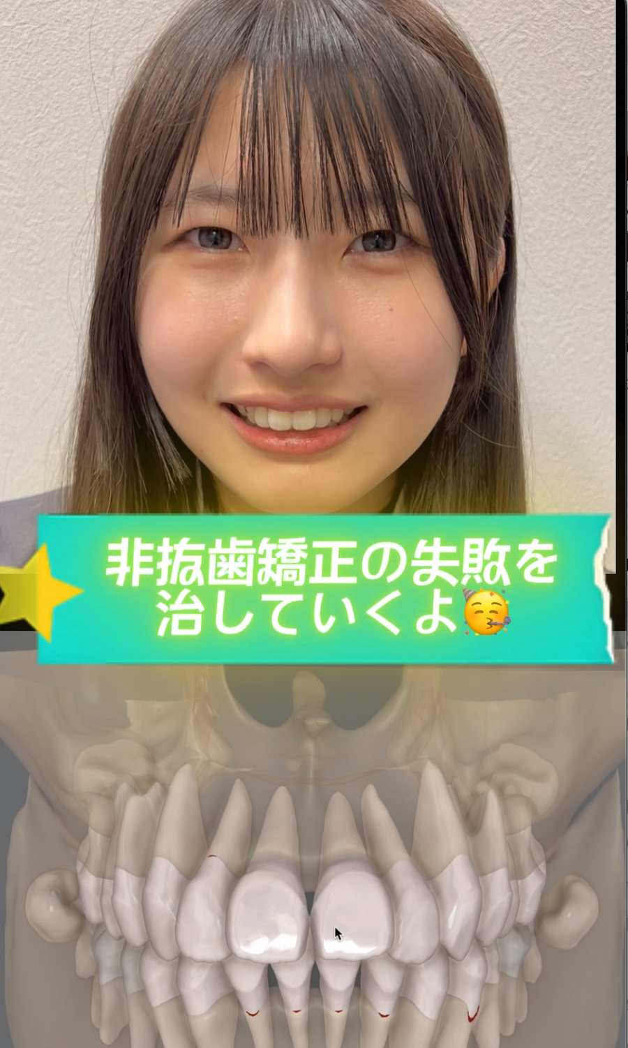 非抜歯矯正の失敗を治していきます！！ - 本町の矯正・歯科 本町