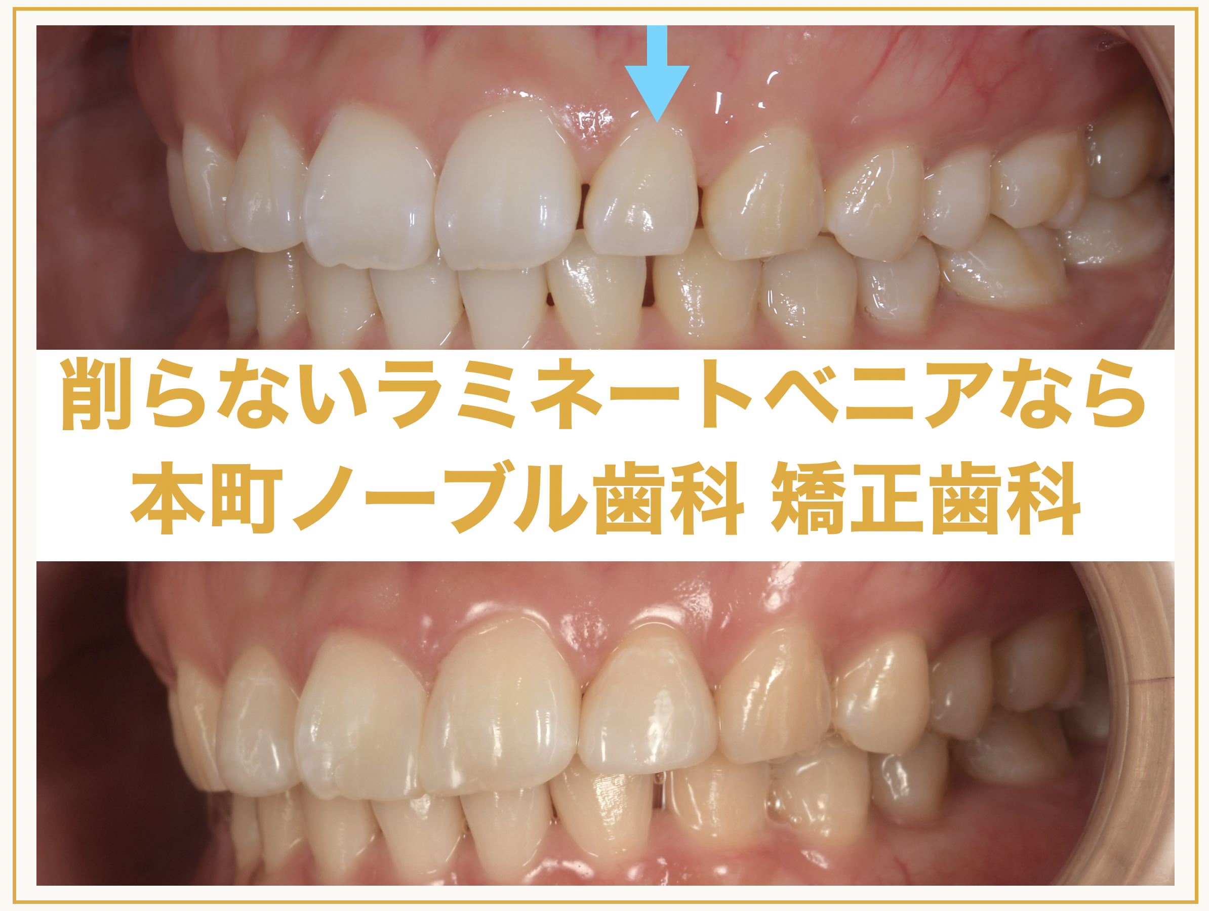 大阪で削らないラミネートベニアをするなら本町ノーブル歯科 矯正歯科
