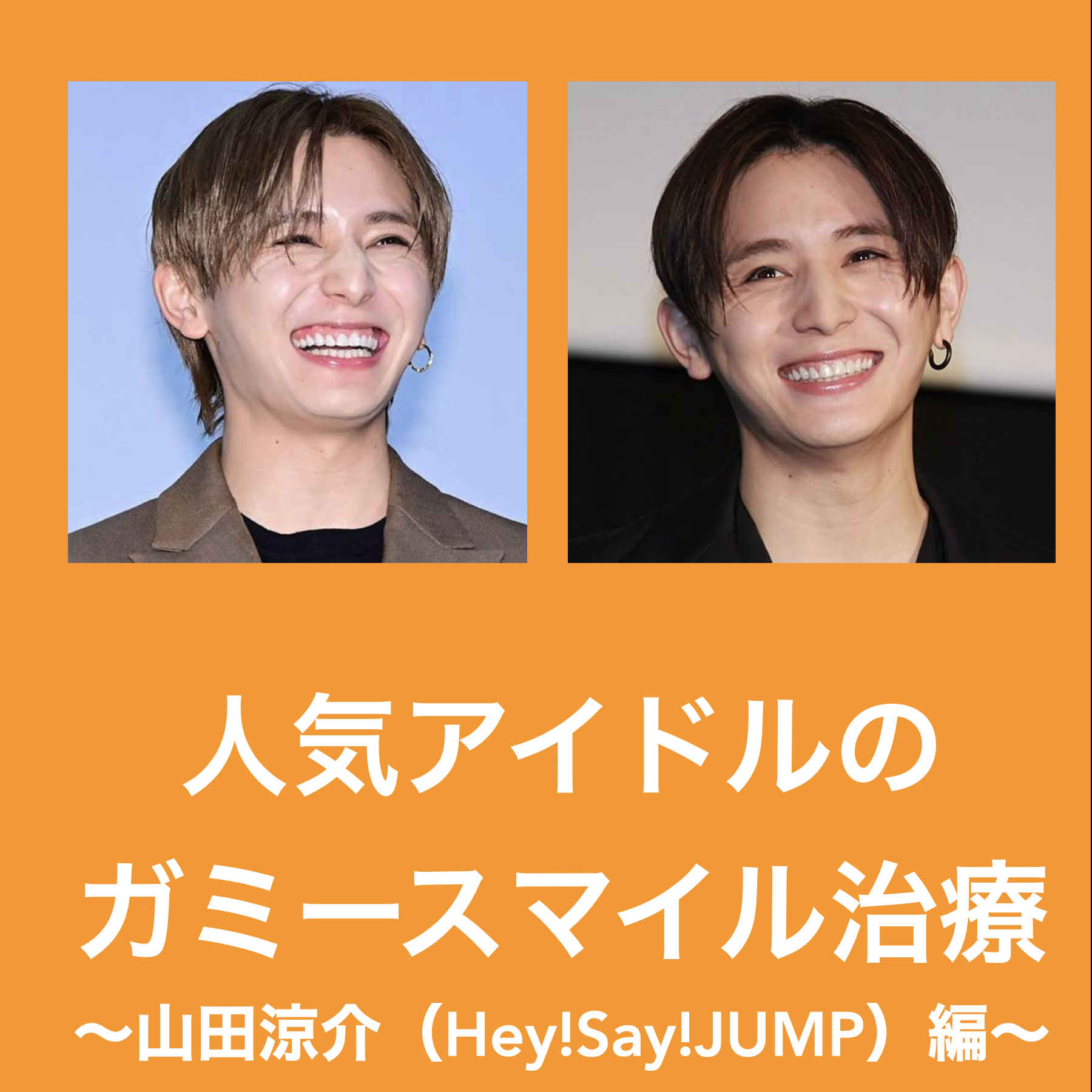 人気アイドルのガミースマイル治療～山田涼介（Hey!Say!JUMP）編