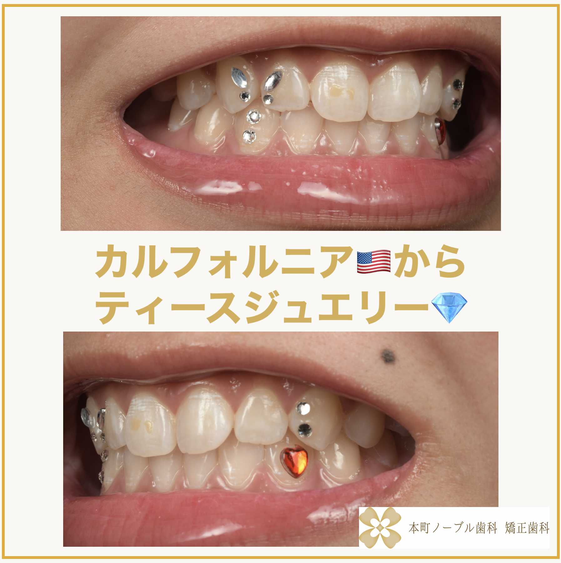 カルフォルニア🇺🇸からティースジュエリーの付け直しと追加でご来院し