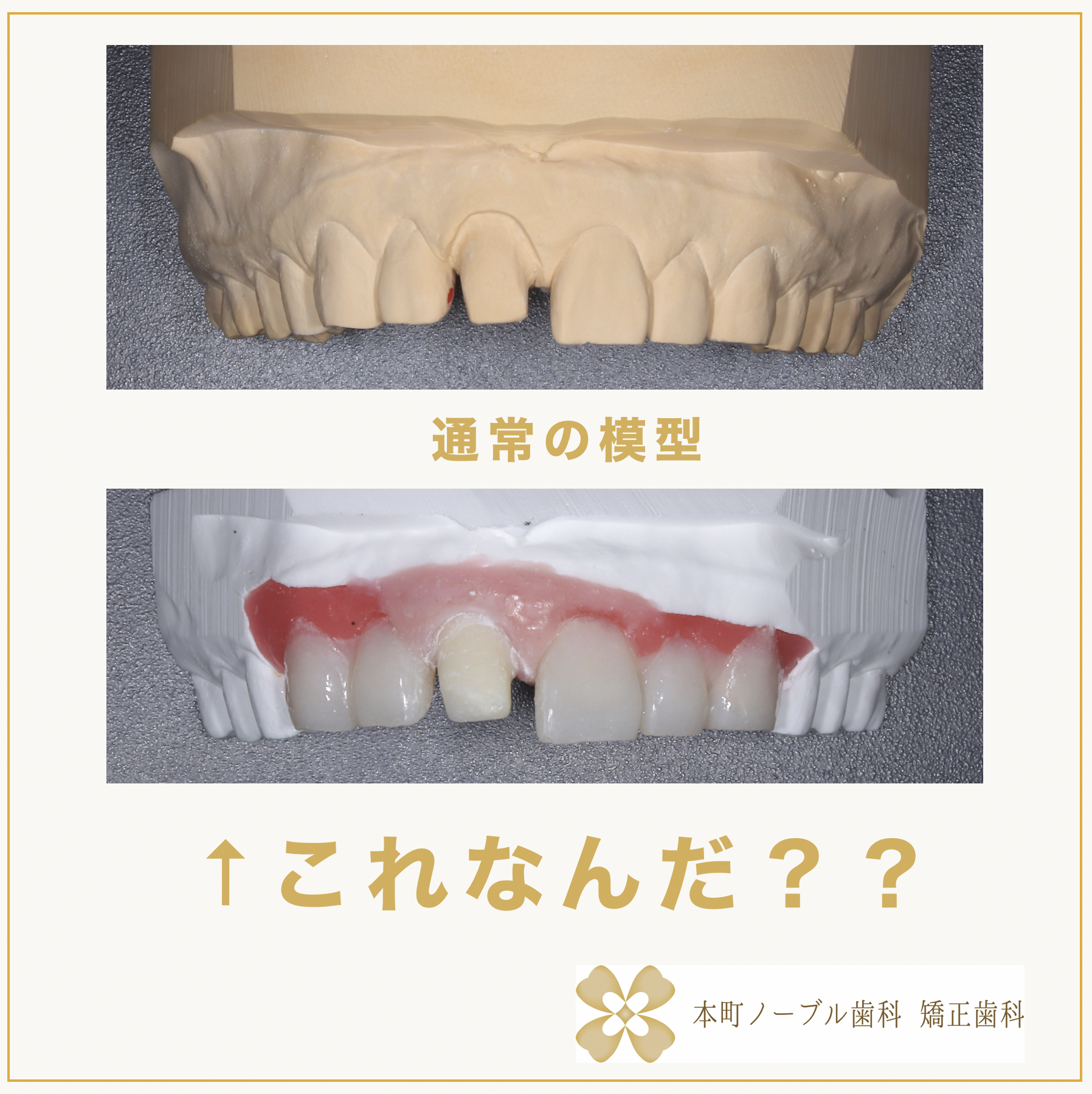 歯科 セラミックサンプル 擬似歯肉付き セラミックで色合わせの精度を上げる擬似支台歯とは？ - 本町の矯正