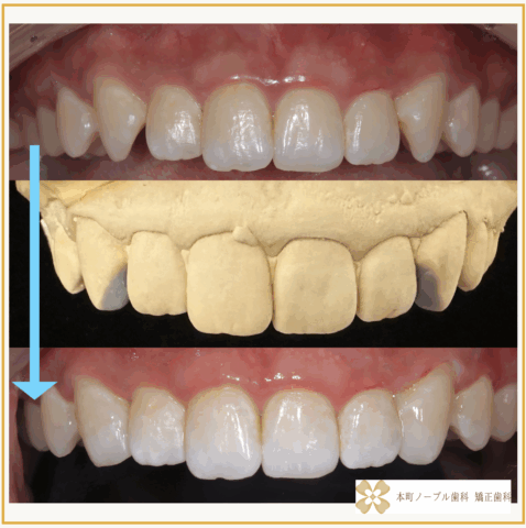 とがって、斜めにはえてることですきっ歯で攻撃的に見える八重歯を歯を