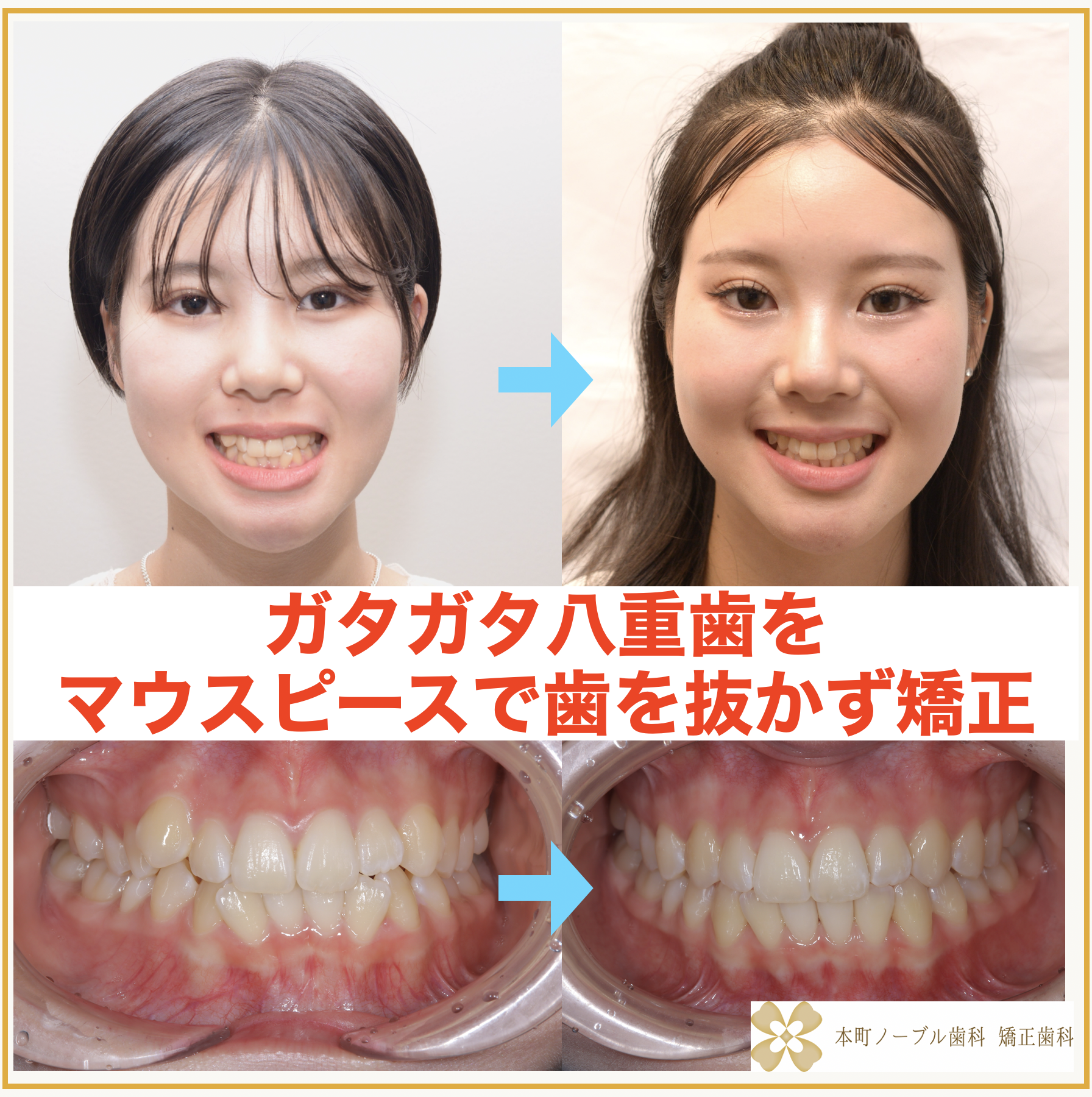 中学生でもできる！ガタガタ八重歯を歯を抜かずマウスピース矯正で治療