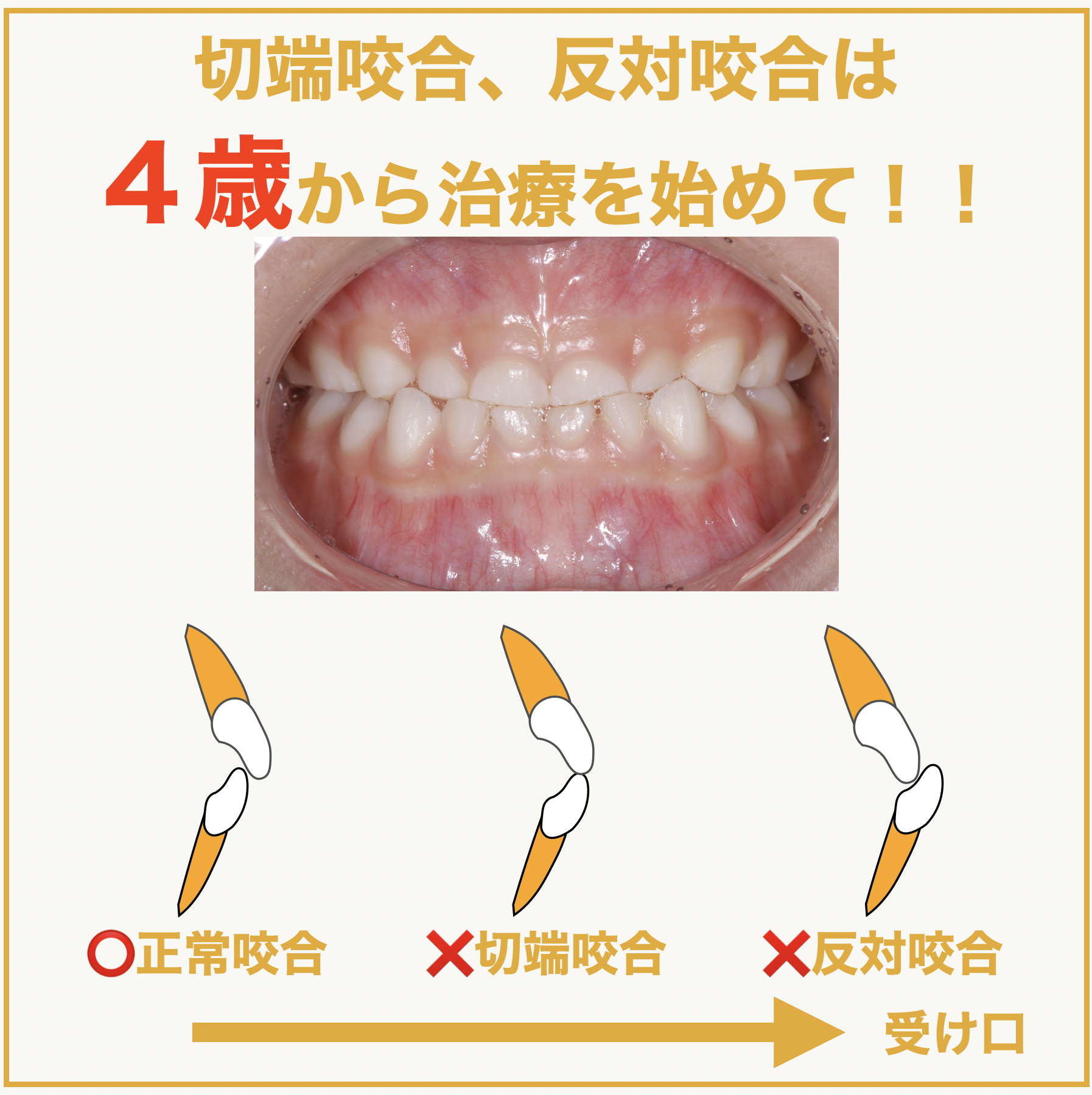 切端咬合、反対咬合は4歳から治療を始めて！！ - 本町の矯正・歯科
