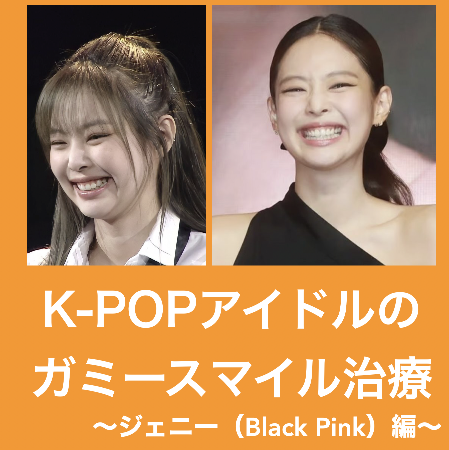 K-POPアイドルのガミースマイル治療〜ジェニー（BLACKPINK）編